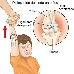 Dislocación del codo en niños