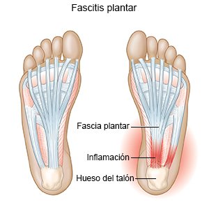 Fascitis plantar