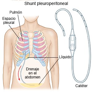 Shunt pleuroperitoneal