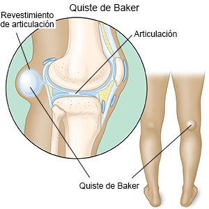 Quiste de Baker
