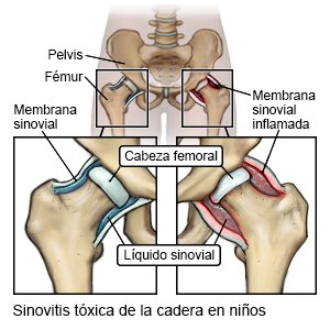 Sinovitis tóxica de la cadera en niños