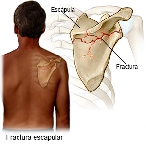Fractura escapular