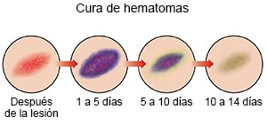 Cura de hematomas