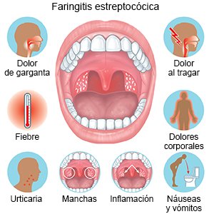 Faringitis estreptocócica