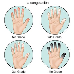 La congelación