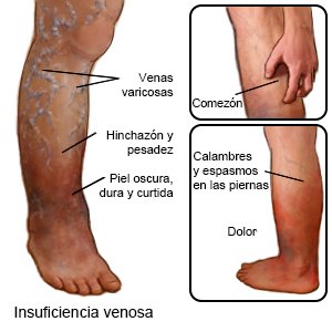Insuficiencia venosa
