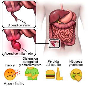 Apendicitis