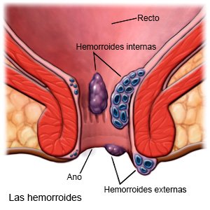 Las hemorroides