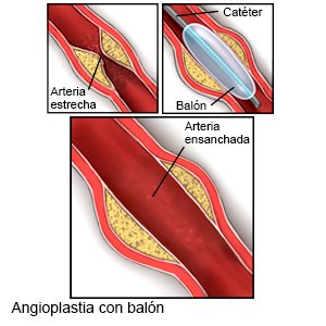 Angioplastia con balón