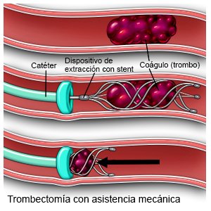 Trombectomía con asistencia mecánica