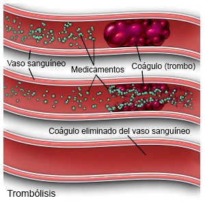 Trombólisis