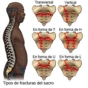 Fractura sacral