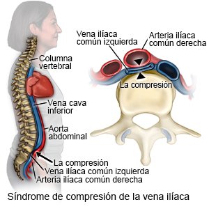 Síndrome de compresión de la vena ilíaca