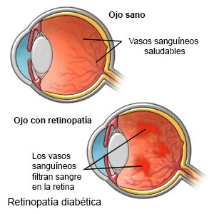 Retinopatía diabética