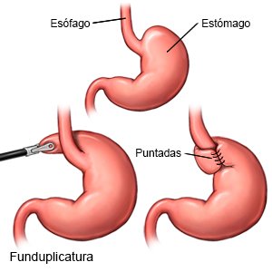 Funduplicatura