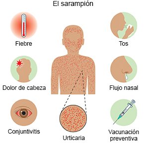 El sarampión
