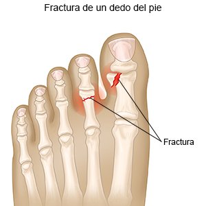 Fractura de un dedo del pie