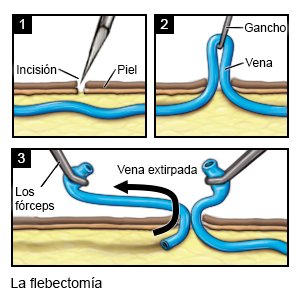 La flebectomía