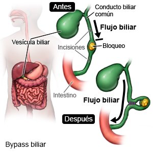 Bypass biliar