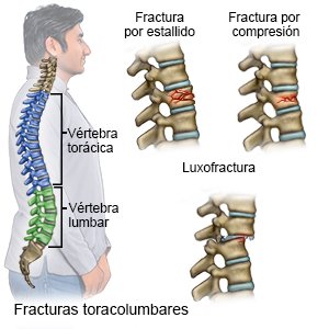 Fractura toracolumbar