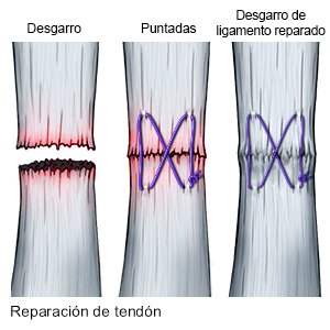 Reparación de tendón