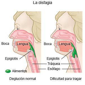 La disfagia