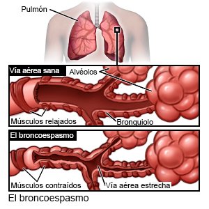 El broncoespasmo