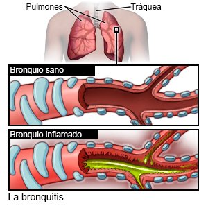 La bronquitis