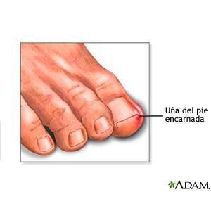 El tratamiento eficaz del hongo sobre las uñas por los medios públicos