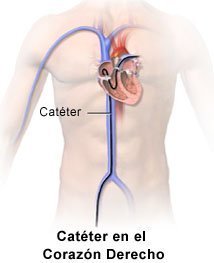 que es un cateter en el corazon