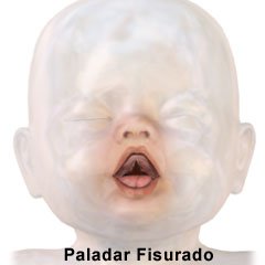 Picture of underside of mouth of cleft palate