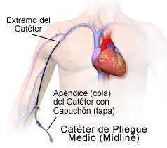 que es un cateter en el corazon que es un cateter en el corazon