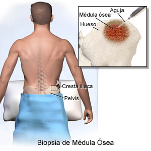 Bone Marrow Biopsy