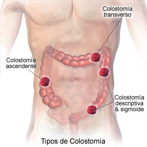 Colostomy Types