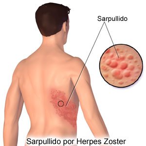 Herpes en la espalda dolor