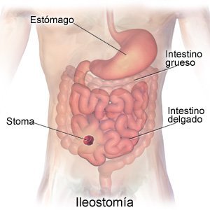 Ileostomy