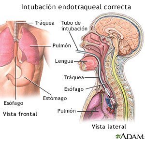 Proper Endotracheal Intubation