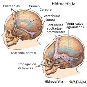 La hidrocefalia es