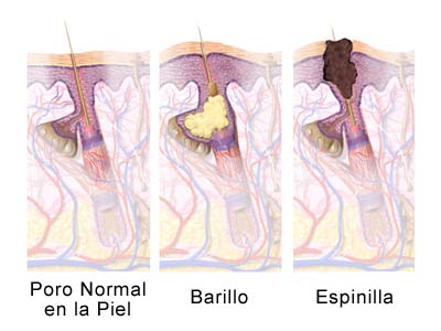 Que tratar la junta después de los plásticos del pecho