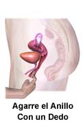 Inserci n Del Aro Vaginal Para Los Sintomas De La Menopausia Care