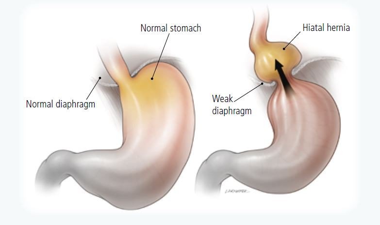 abdominal hernia in adults