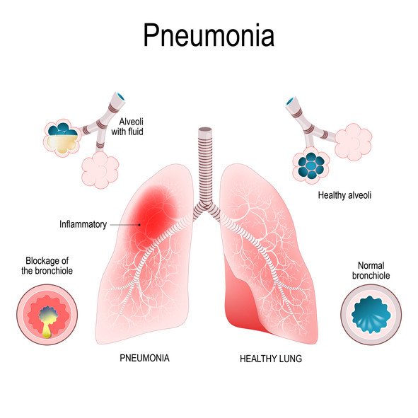 cap pneumonia คือ side effects