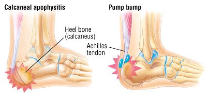 sore inside heel