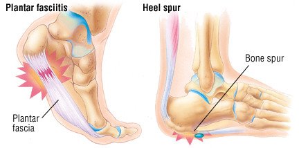 burning heel pain in cast