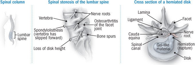 Herniated Disc: Symptoms, Causes, Diagnosis & Treatments - Mater