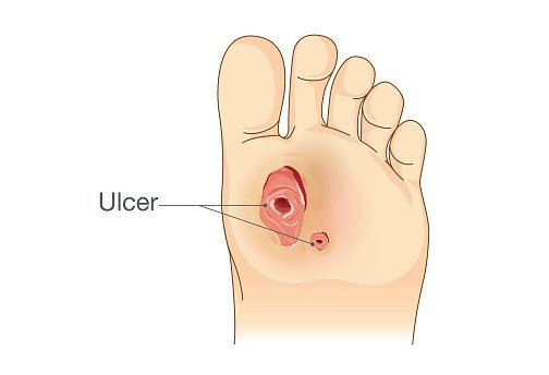 Foot Ulcers Guide: Causes, Symptoms and Treatment Options