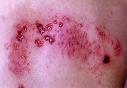 Shingles (herpes zoster)