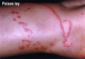 Contact Dermatitis