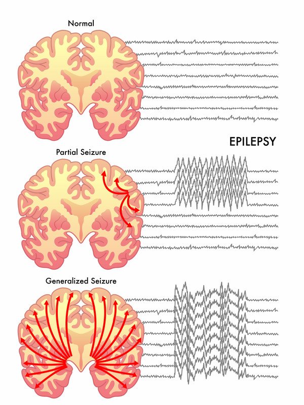 Seizure