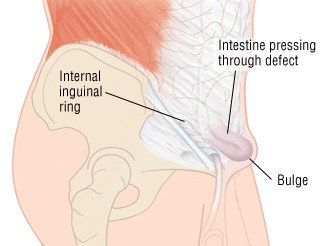 Onstep Hernia Repair Decreased Postop Pain During Sexual Activity